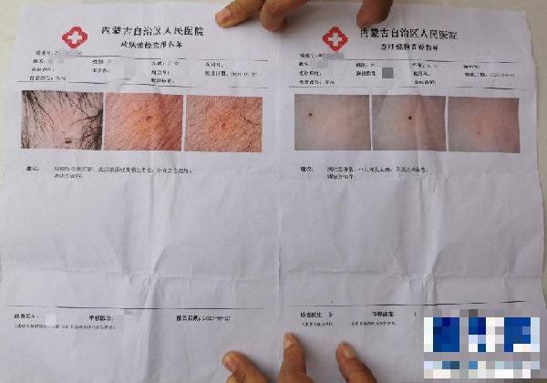 檢查報告顯示，孩子身上有多個疑似被針扎的痕跡。 圖片來源：翻攝自微博