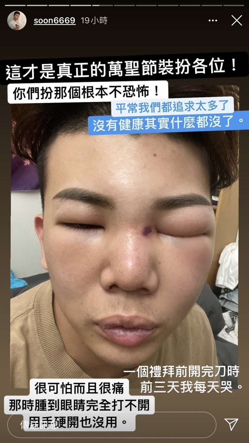 孫生曝光自己左眼整個腫了起來，半邊臉腫到變形的照片，並透露一星期前他開刀後的前3天，每天都在哭。 圖：翻攝Instagram
