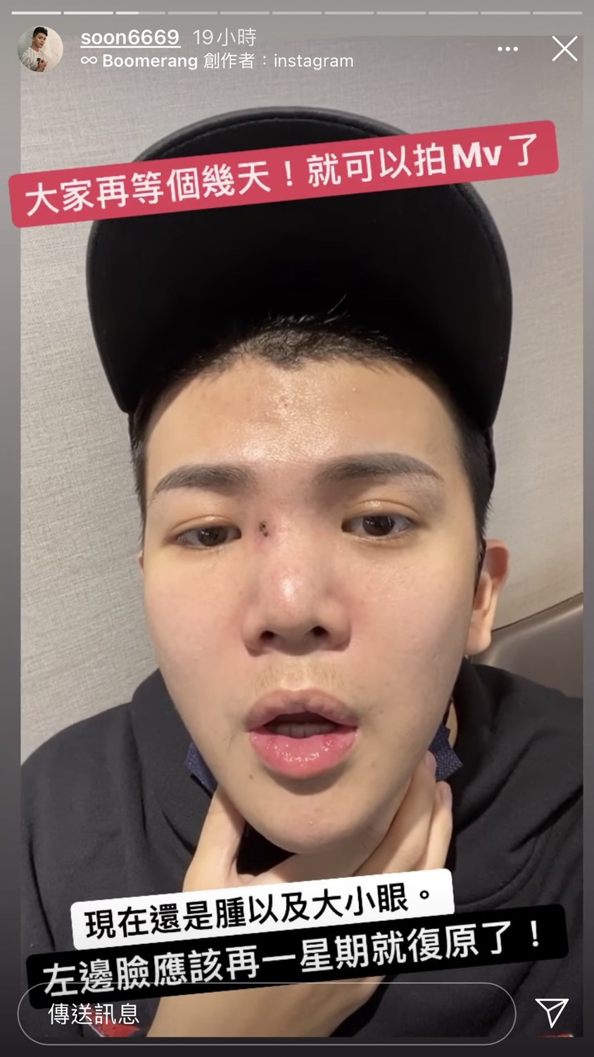 目前孫生回復狀況還不錯，腫起來的左眼也稍微消腫了，他說應該再一星期就可以復原了。 圖：翻攝Instagram