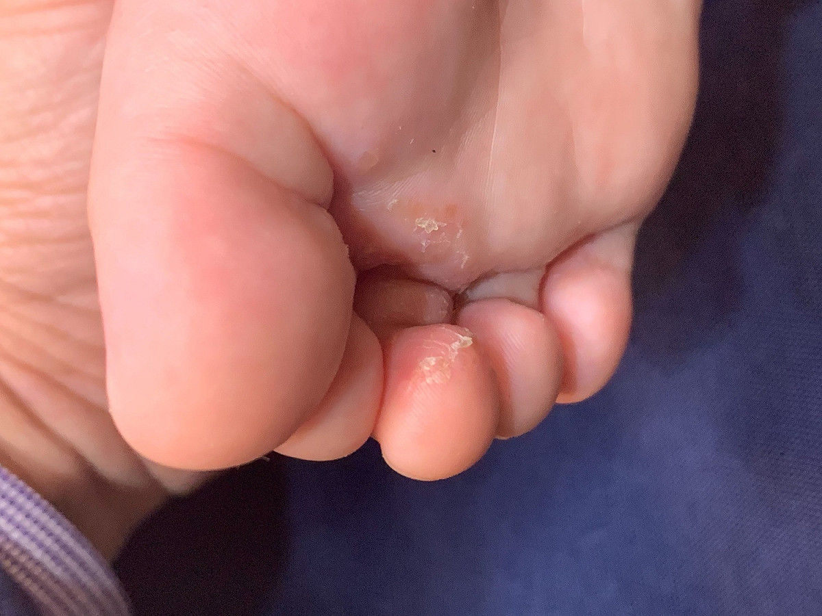 皮膚科醫師黃柏翰表示，雖然嬰幼兒不容易感染香港腳，若是家中地板滿是大人的皮屑，就很容易傳染給幼童。 圖：黃柏翰醫生/提供