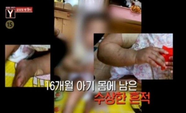 女童受虐痕跡。 圖：翻攝自韓網