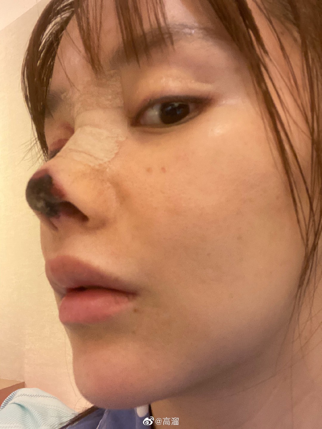高溜整形失敗導致鼻尖發黑壞死。 圖：翻攝自微博