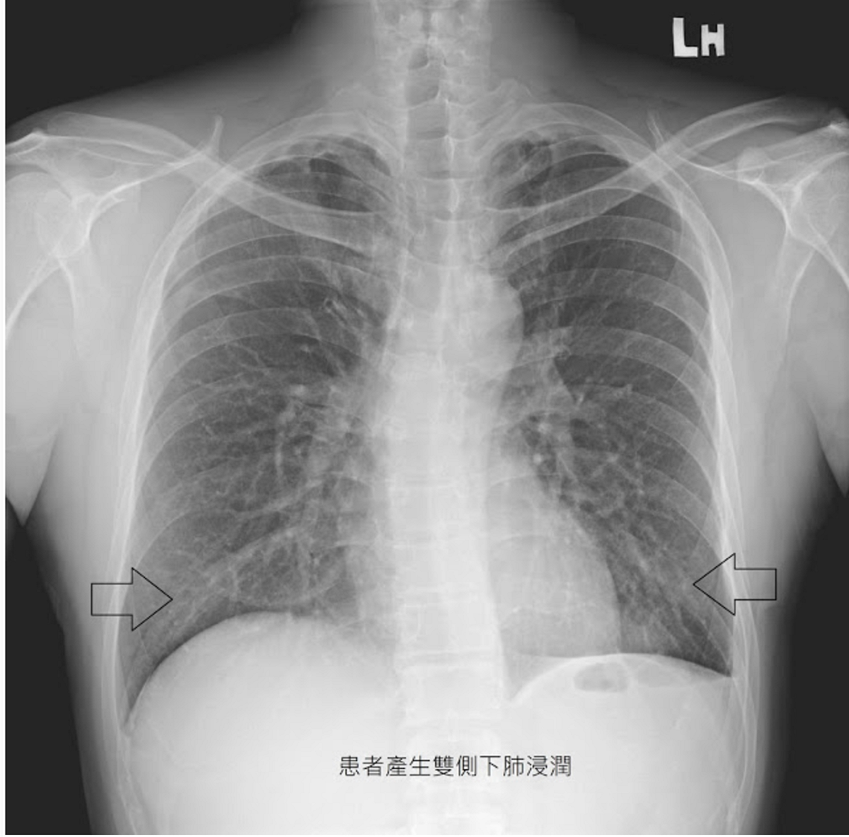 蘇一峰指出，電子煙害人不淺，該名壯漢在抽電子煙一年後，產生雙側下肺浸潤的狀況。 圖：蘇一峰/提供