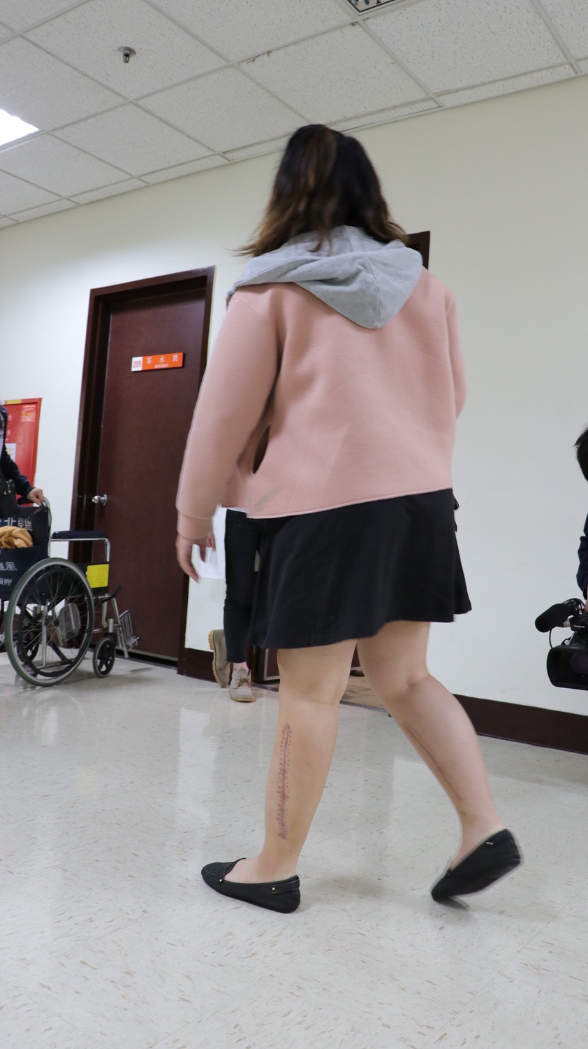 陳小姐雙腿因「再灌流症候群｣腫脹，造成腔室症候群壓迫到動脈血流，由整形外科進行筋膜切開術後，傷口漸漸癒合。 圖：台北榮總/提供