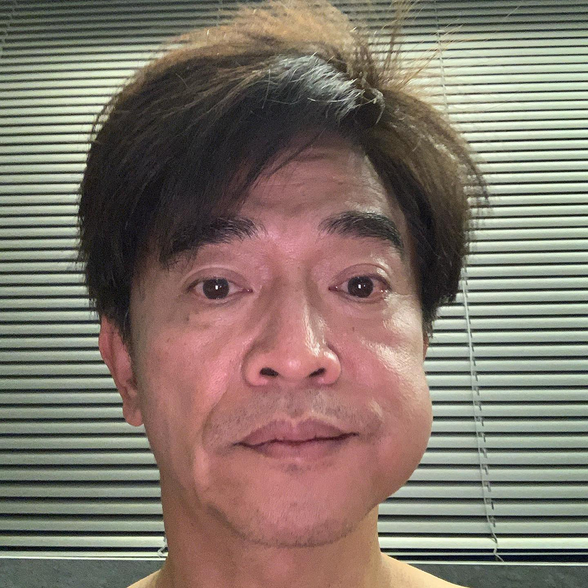 吳宗憲因植牙導致臉腫成豬頭。 圖：翻攝自吳宗憲臉書