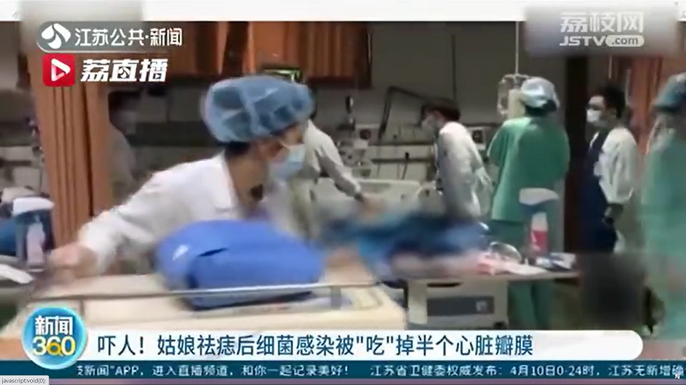 中國浙江一個20歲女生小丁因為做除痣手術，患上「感染性心內膜炎」。 圖：翻攝自微博