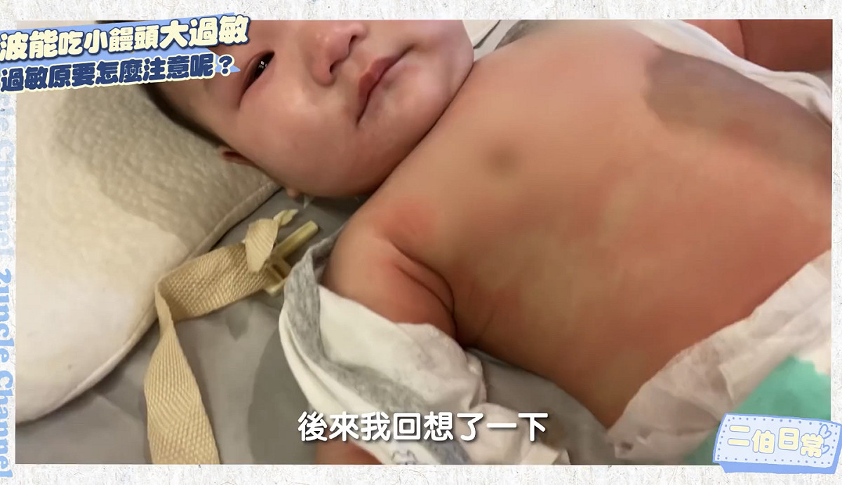 蔡波能因過敏導致全身發紅。 圖：翻攝自嘎嫂二伯&amp;蔡波能`s Daily