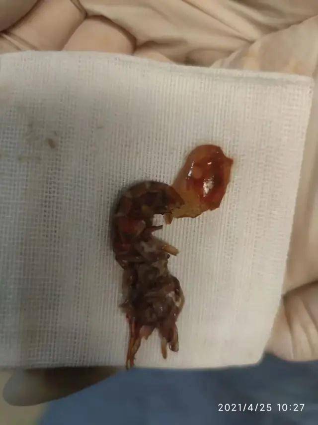 中國浙江一名14歲少年把小龍蝦塞進肛門裡，無辜的小龍蝦被取出後則斷成兩節慘死。 圖：翻攝瀟湘晨報