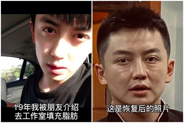 金大威將昔日舊照曝光，勸世「真的不要亂整，能別整就別整」。 圖：擷取自抖音／金大威Abel
