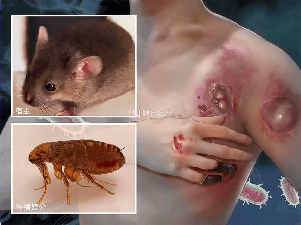 內蒙古鄂爾多斯市出現一名疑似鼠疫的病例。(示意圖) 圖 : 翻攝自騰訊醫典