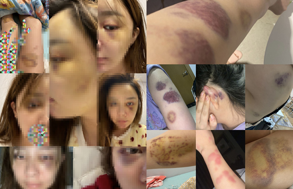 爆料女性小雅po出遭雷姓男子長期毆打的照片。 圖：翻攝自微博
