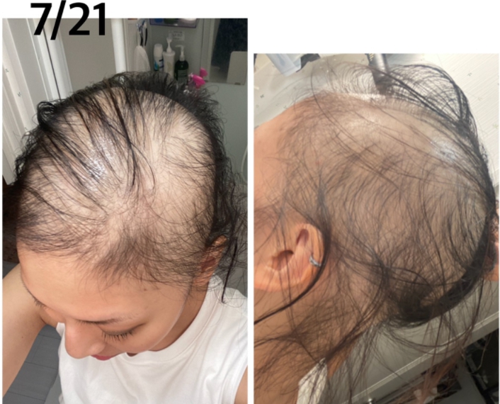 日本一名女性表示自己接種完莫德納疫苗後，出現嚴重脫髮現象。 圖：翻攝自ameblo.jp