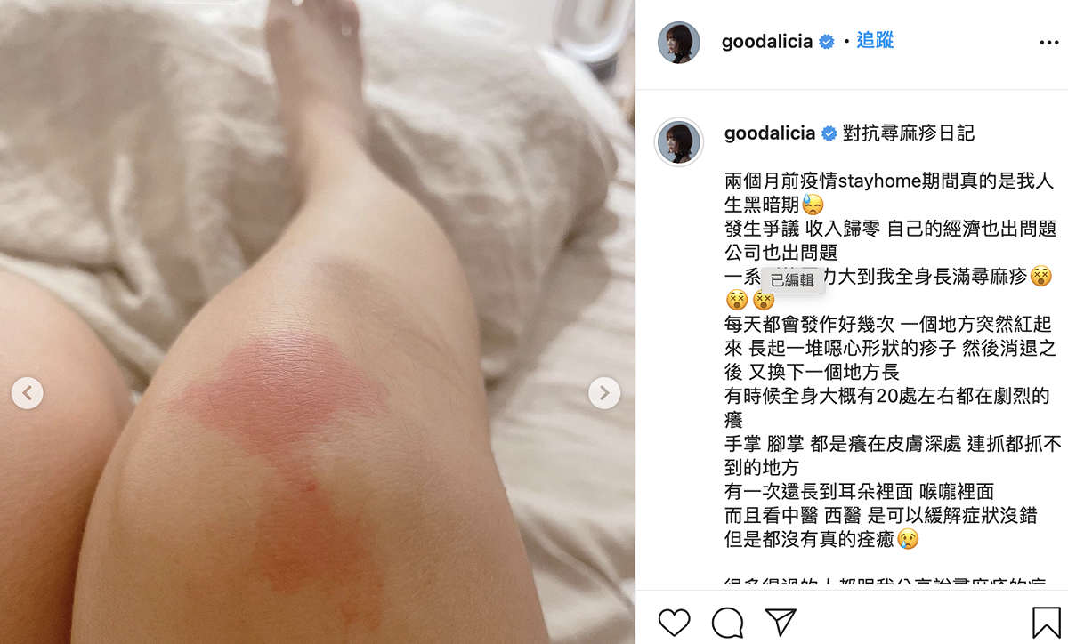 愛莉莎莎發照表示身體多處紅癢。 圖：翻攝IG/愛莉莎莎