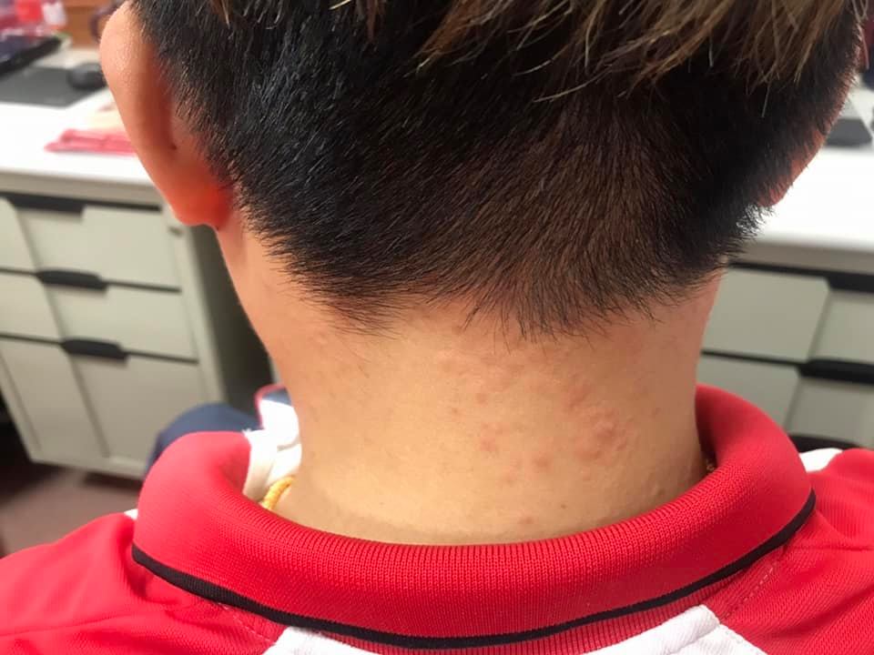 澎湖縣近來出現不明怪病，許多民眾紛紛在臉書上表示，自己身上出現紅疹，且奇癢無比，紛紛至診所及醫院看診 圖:蘇育德臉書