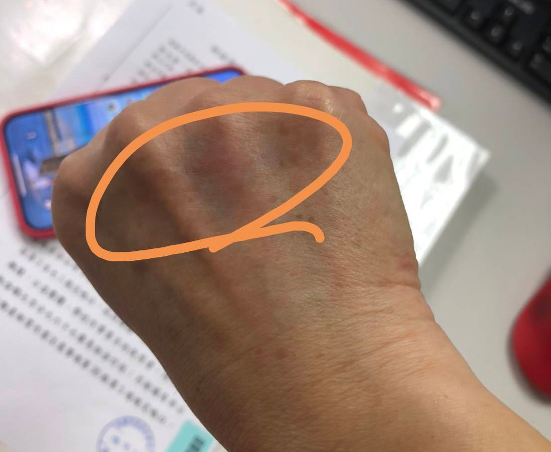 社工手被鐵門夾傷紅腫。 圖：高市社會局提供