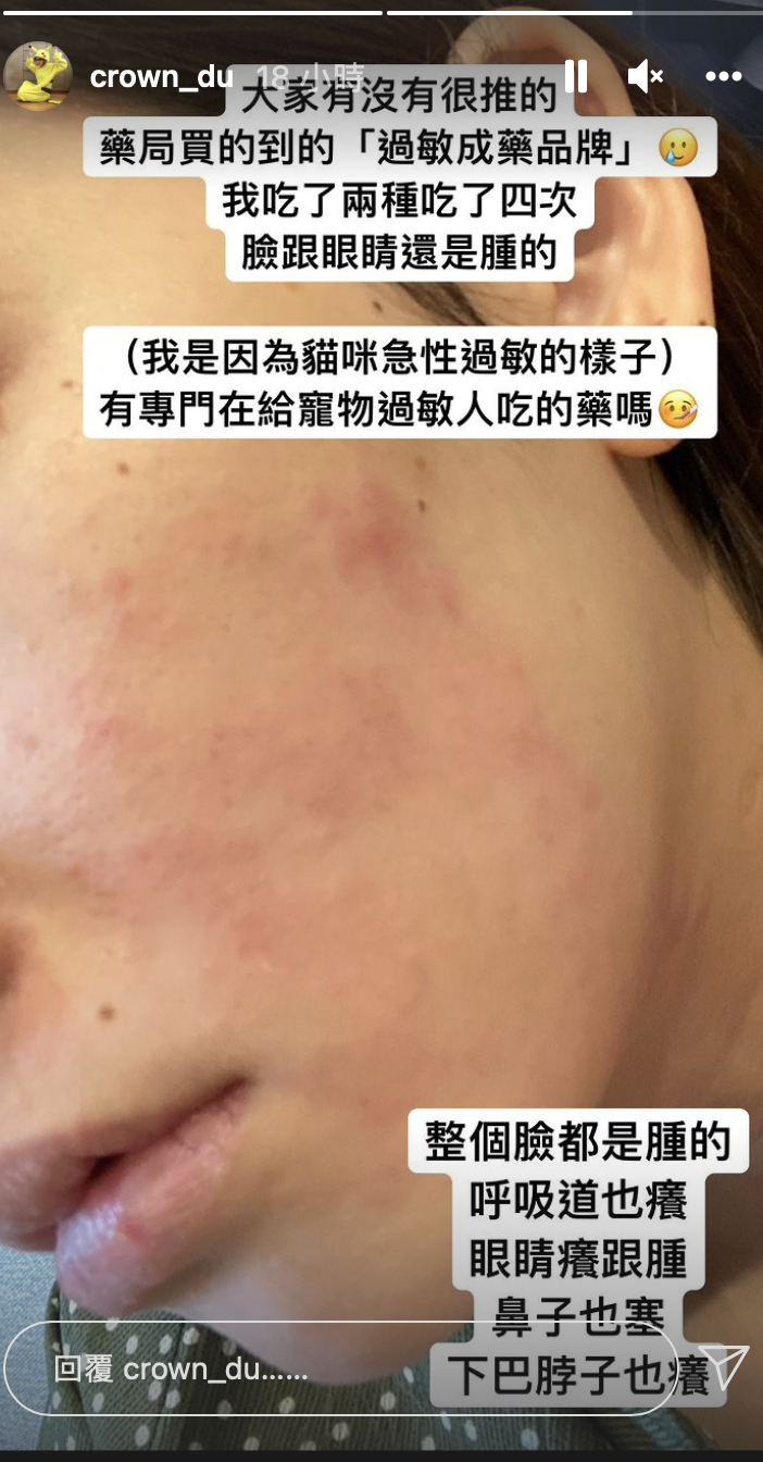 滴妹疑似急性過敏導致臉部發紅。 圖：翻攝IG/滴妹