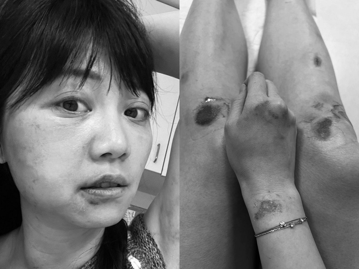 高嘉瑜遭男友林秉樞殘忍毒打，傷勢令人怵目驚心。 圖：高嘉瑜提供