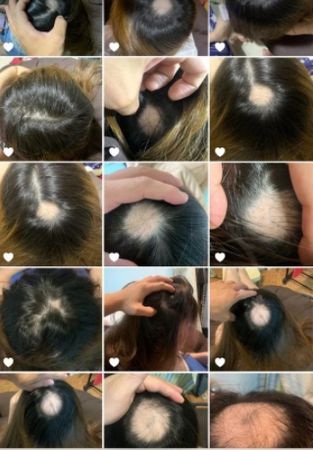 女網友表示，她積極吃藥治療，落髮範圍卻反而從10元大小變雞蛋大小。 圖：翻攝Dcard