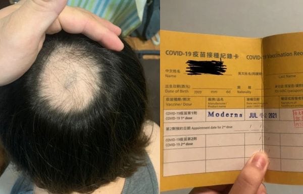 一名女網友表示，今年7月初造冊接種莫德納疫苗，過沒幾天就出現禿頭副作用。 圖：翻攝Dcard
