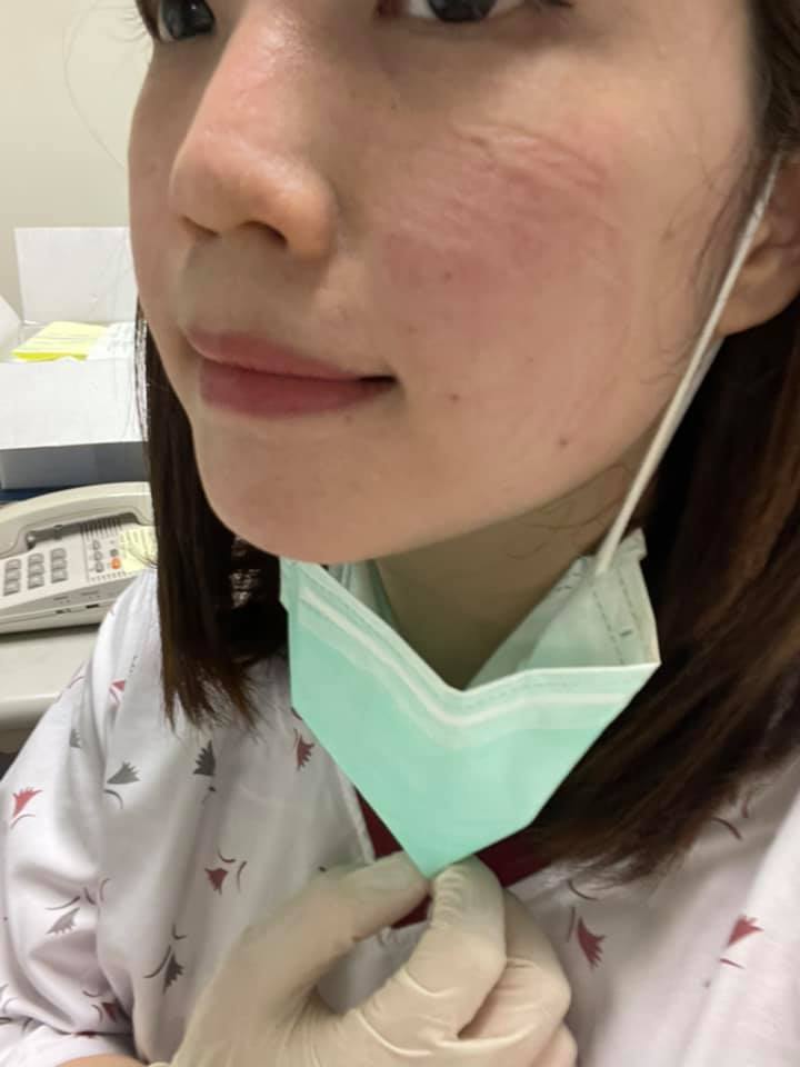 疫情嚴峻期間，黃思婷以護理人員身分協助篩檢工作，因長時間帶防護面罩，臉上留下痕跡。 圖：黃思婷/提供