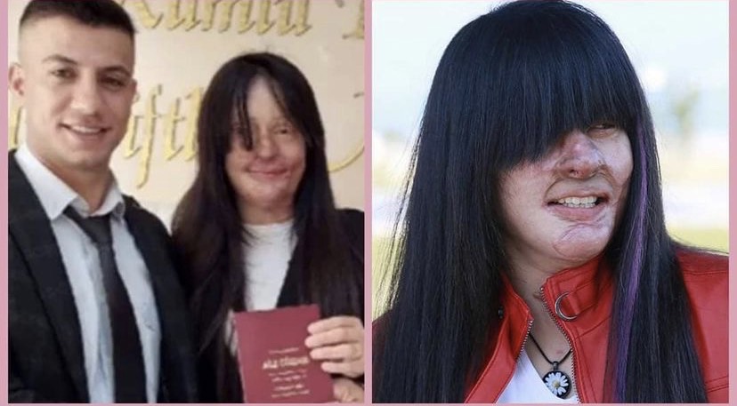 20歲的土耳其人歐塞克（Berfin Ozek）於兩年前遭23歲男友塞爾提克（Casim Ozan Celtik）朝自己臉上潑硫酸攻擊，這使她毀容並幾近喪失視力。然而本月稍早，他們倆結婚了。 翻攝自：Instagram Anatolia_Turc YK