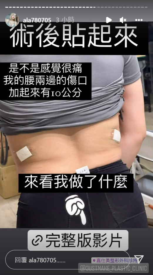 小A辣曝光手術後照片。 圖：翻攝自小A辣IG