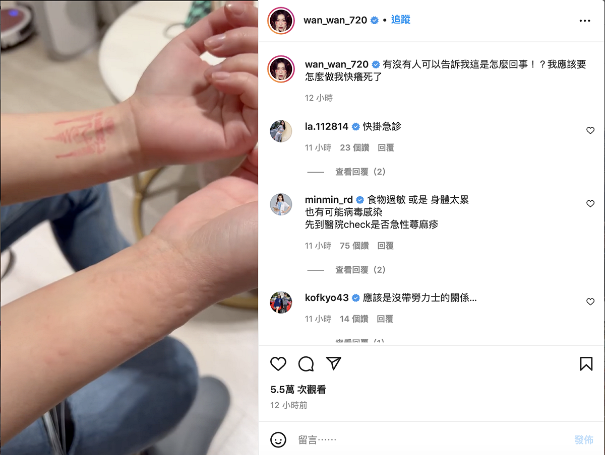 宛宛兒得「急性尋麻疹」。 圖：翻攝自宛宛兒IG(@wan_wan_720)