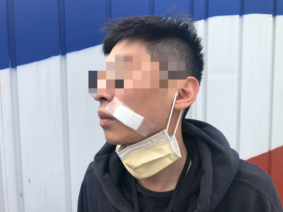 黃姓攔檢員執行排氣檢驗攔檢作業，遭民眾毆打並持安全帽追打，造成該名同仁臉頰及牙齦約10~15公分多處挫傷。