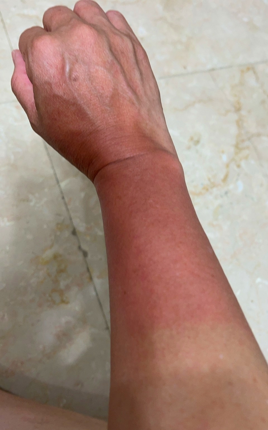 何欣純秀出曬傷的手臂。 何欣純/提供