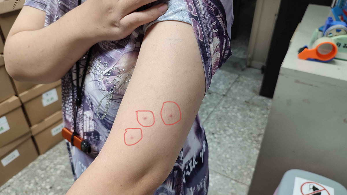 禽蟎咬人皮膚會呈三顆線狀或三角形排列的咬痕，但大多數蟎蟲生命期約3周內死亡。 圖：新北市動保處提供