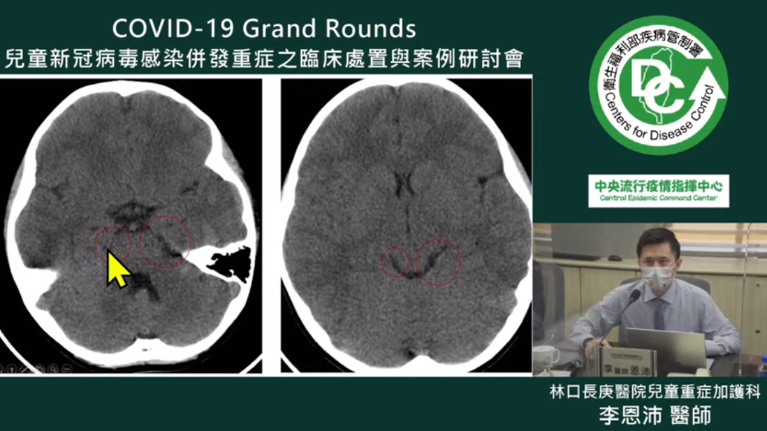 一名7歲確診男童睡覺突瞪眼大喊，送醫發現腦部有腫脹現象。 截自疾管署YouTube