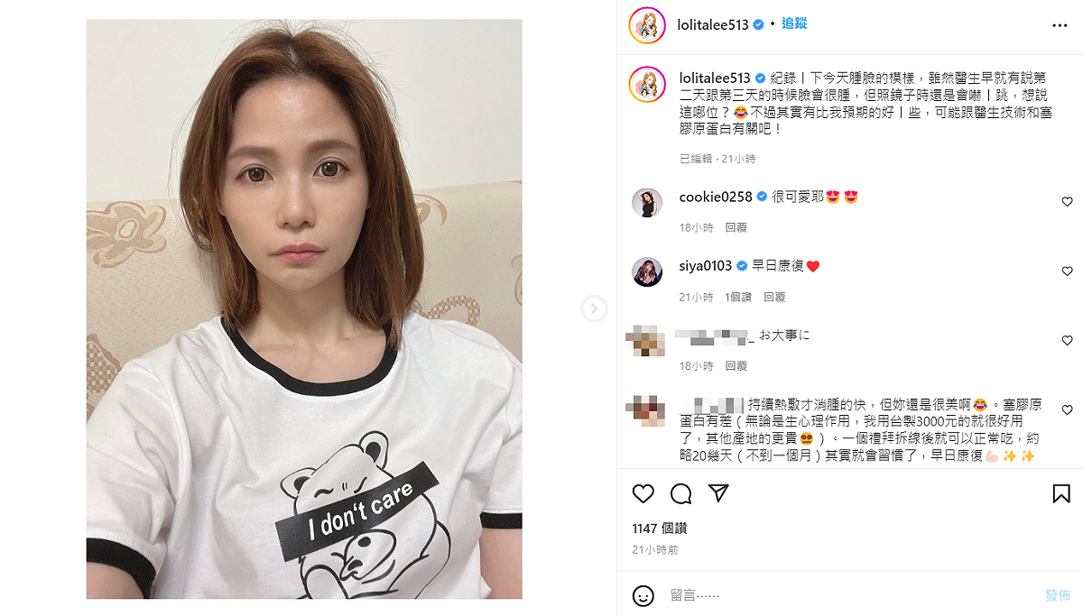 蘿莉塔拔完第2天曬出臉頰腫脹的照片。 圖：翻攝自IG/lolitalee513