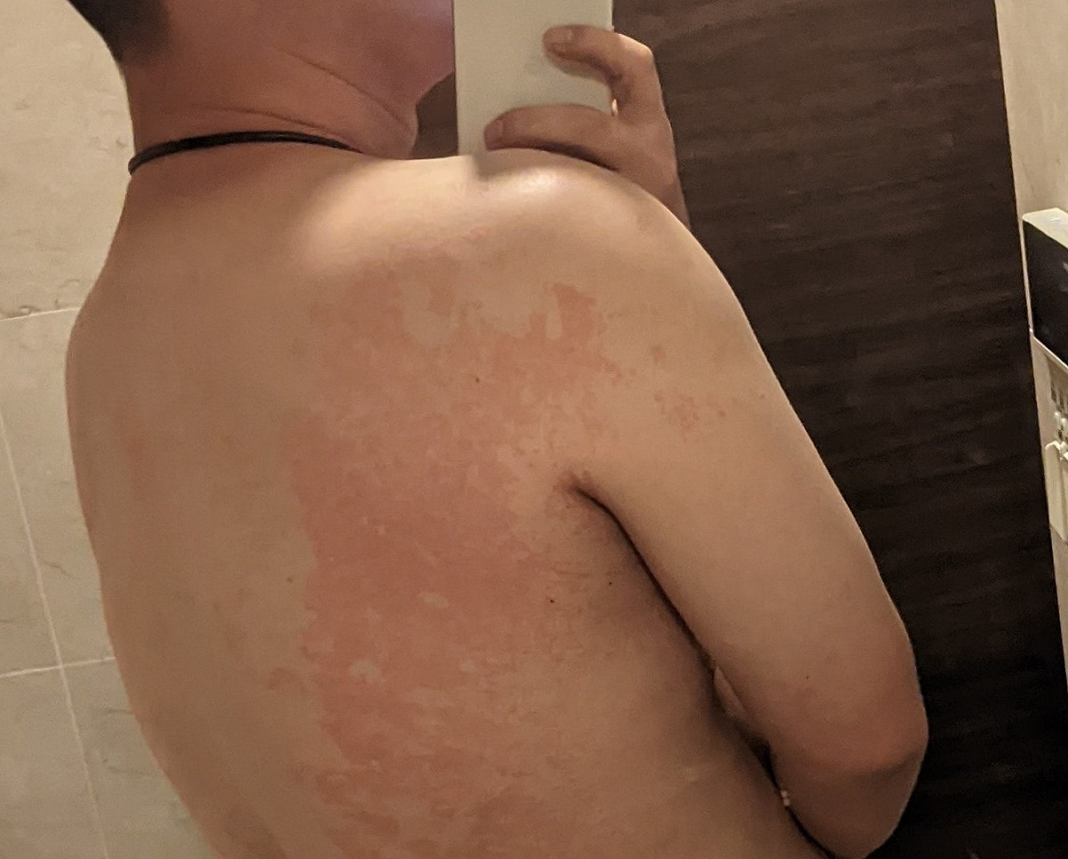 台灣基進前立委陳柏惟昨天深夜在臉書PO出照片，可以看見半邊背都出現蕁麻疹。 圖：擷自陳柏惟臉書