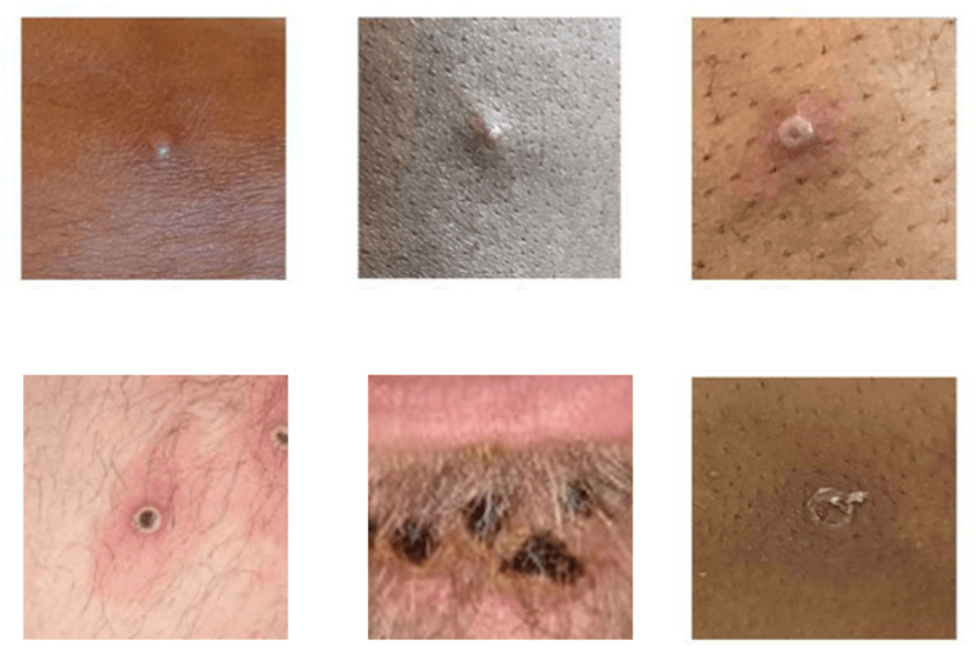 美國CDC介紹感染猴痘皮膚出現症狀。 圖：取自cdc.gov