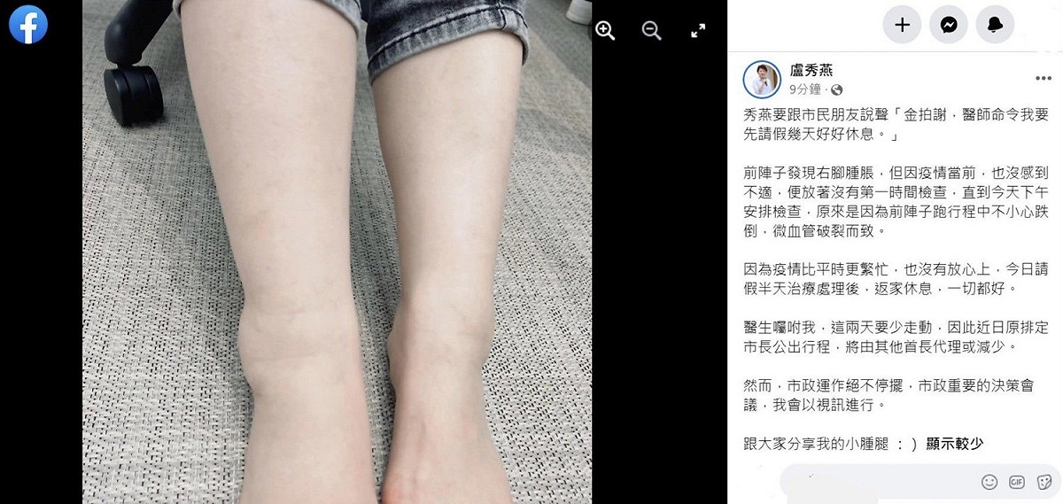盧秀燕因腳傷請假2天。 取自盧秀燕臉書