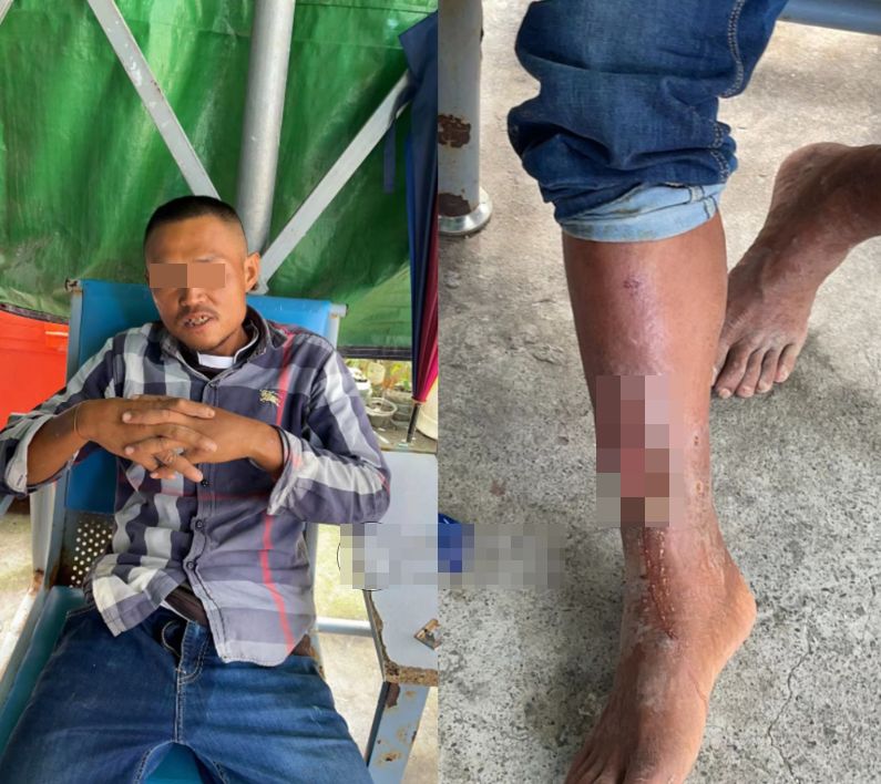 男子被發現時模樣憔悴，左腳脛骨處還有遭利刃挖出一個拳頭大的爛傷口。 圖：翻攝環球博訊