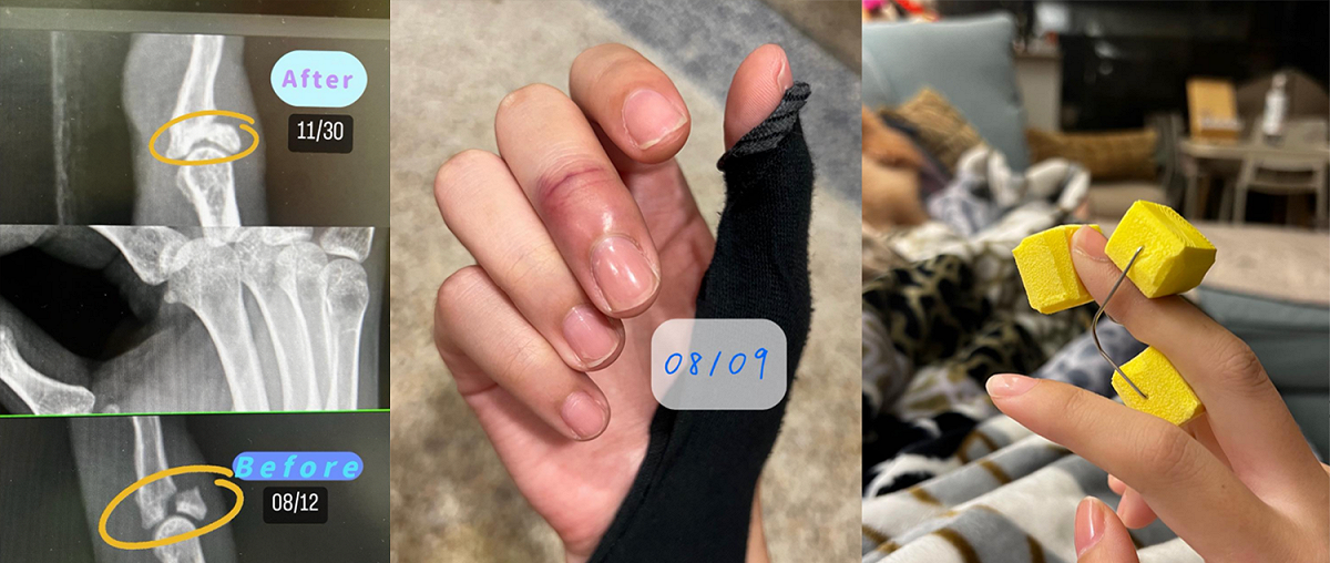 她在IG曝光傷勢照，可看出骨頭直接斷了一角，畫面怵目驚心。 圖：翻攝自田依甯IG