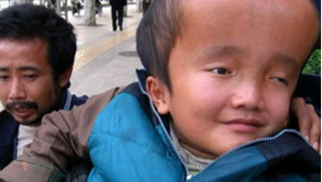 2008年時中國嬰幼兒品牌三鹿，在奶粉裡摻入三聚氰胺，讓嬰幼兒喝了以後成為「大頭寶寶」模樣驚人！也造成日後中國人至香港與他國搶購奶粉，曾一度讓香港人無法買到奶粉。 圖：翻攝自勝訊網-「彤妈说育儿」網頁