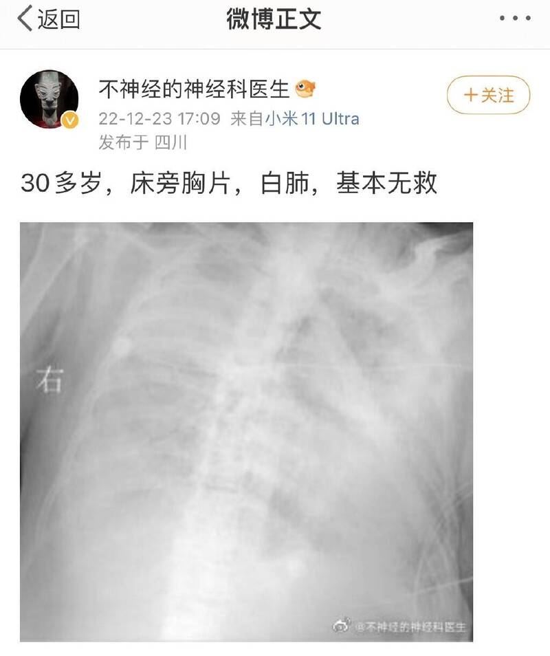 醫生在微博發佈病患的肺部 X 光照，並表示白肺難以治癒。 圖：翻攝自 微博