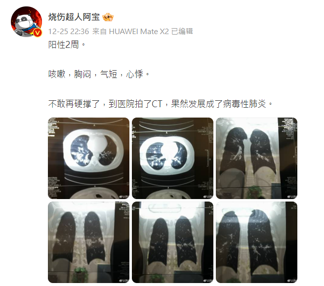 中國網紅燒傷科醫生「燒傷超人阿寶」在微博上發文，稱自己陽性兩周，出現嚴重症狀才就醫。 圖:翻攝自「燒傷超人阿寶」微博