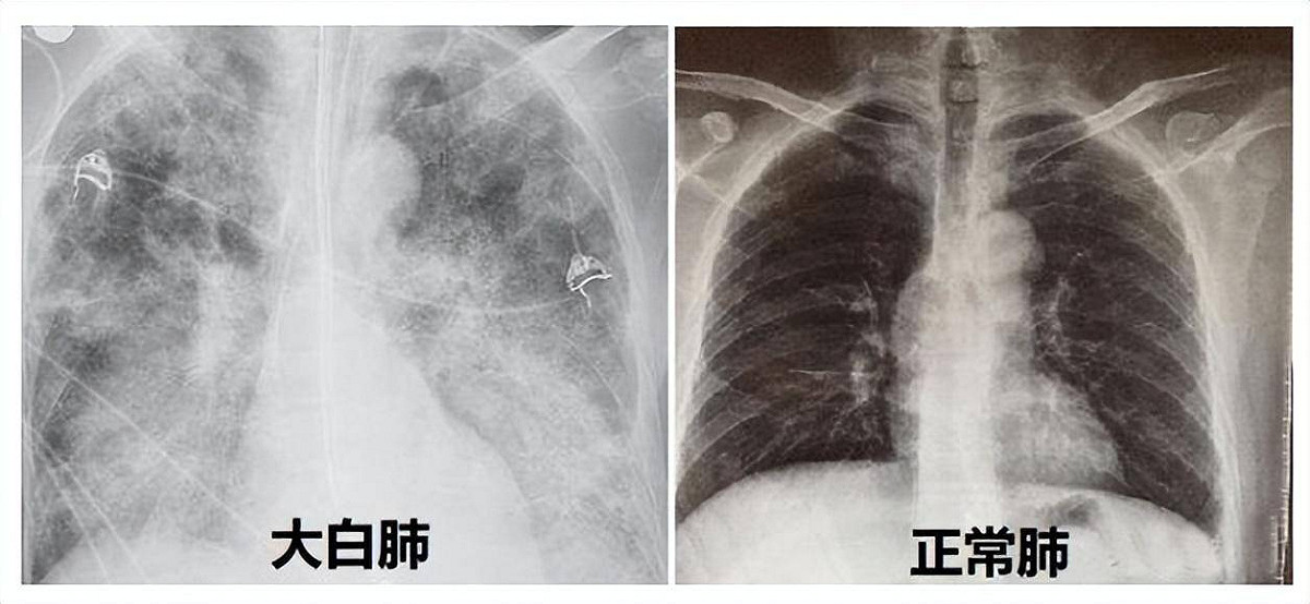 網傳許多「大白肺」圖片，中共官方趕緊闢謠。 圖：翻攝自搜狐（資料照）