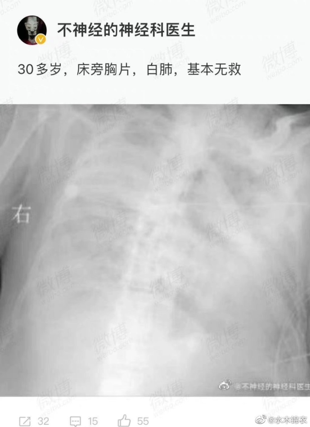 網傳許多「大白肺」圖片，中共官方趕緊闢謠。 圖：翻攝自搜狐（資料照）