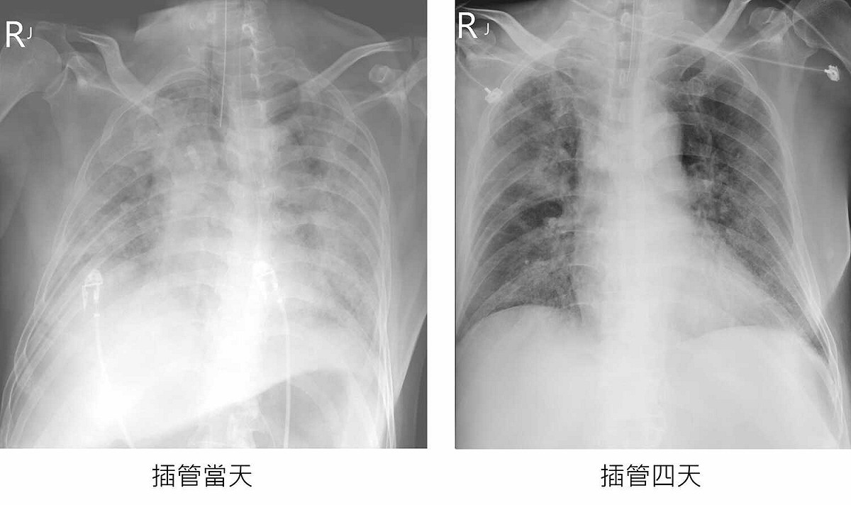 蘇一峰稍早也PO文更新該名台商的狀況，指出目前X光照片也可以看到，大白肺台商雖還沒脫離險境，但插管4天後狀況好轉許多。 圖：翻攝自蘇一峰臉書專頁