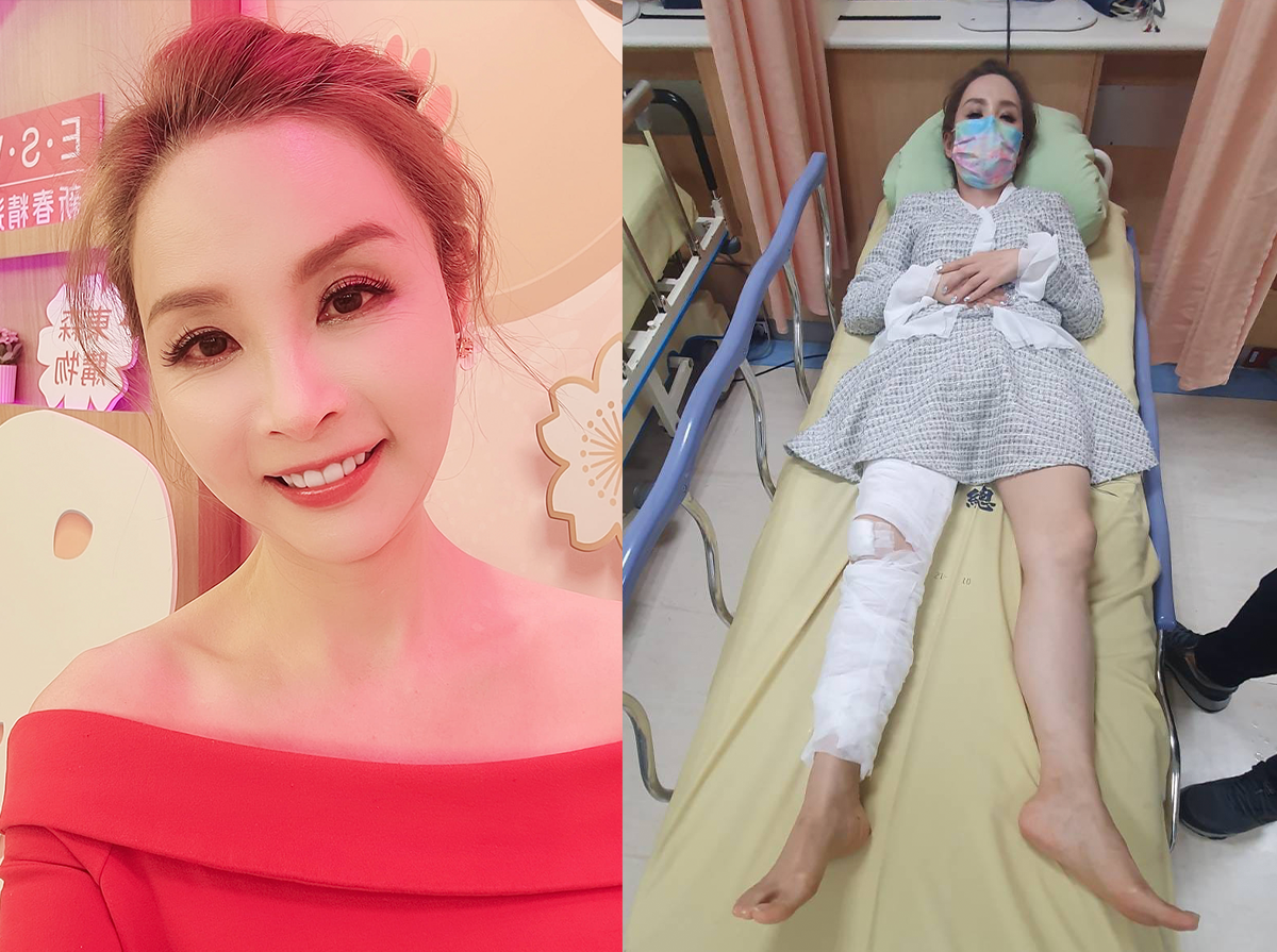 資深名嘴許聖梅透露自己不慎摔倒，意外將膝蓋摔碎。 圖：翻攝自許聖梅FB