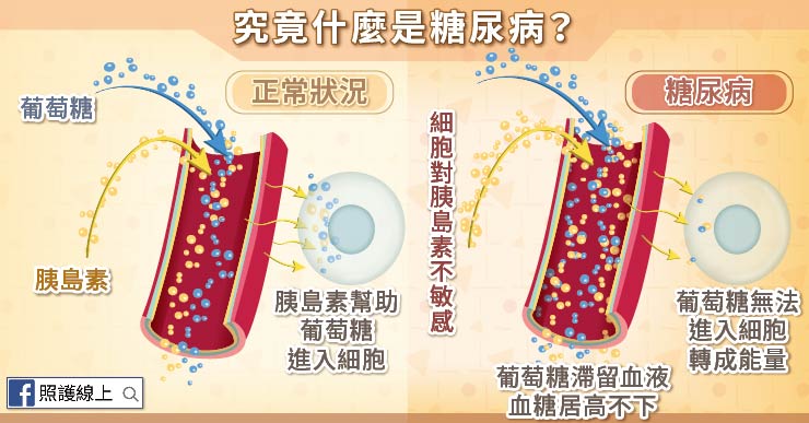 糖尿病患者的細胞，對胰島素的反應不靈敏，因此即便胰島素出現在血液中，細胞依舊無動於衷，無法讓血液中的糖進到細胞內利用。 圖：照護線上／提供