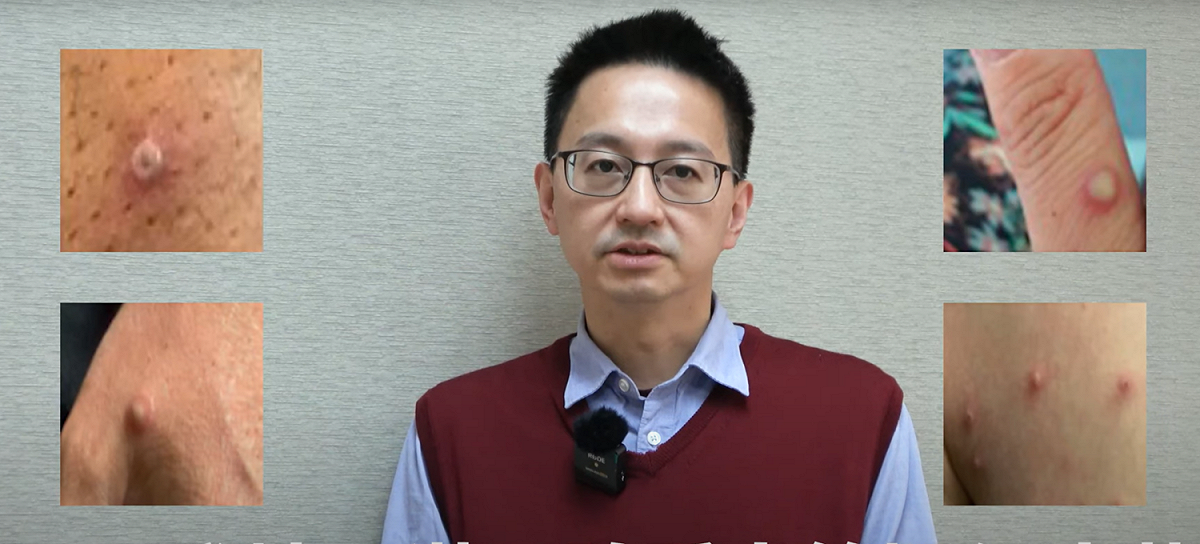 疾管署副署長羅一鈞提醒，猴痘應落實自我防護，並避免出入可能與不特定人士密切接觸之社交活動等高風險場域，如出現：皮疹、水泡、斑疹、斑丘疹、膿疱等疑似症狀，應儘速就醫。 圖：翻攝自疾管署影片