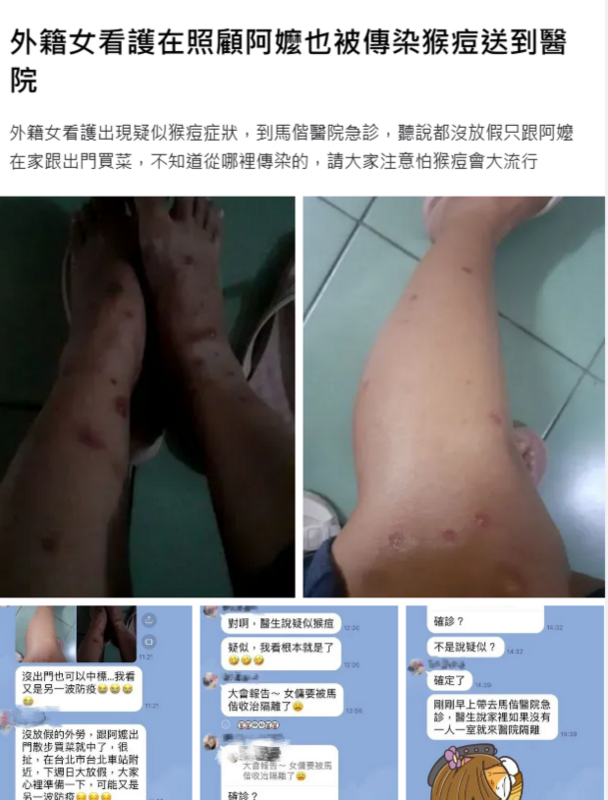 「爆料公社」一文指一名外籍女看護照顧阿嬤時卻被傳染猴痘，已收治隔離並確診。疾病管制署副署長羅一鈞今指出女看護檢驗結果呈現陰性，已經出院。 圖：翻攝自爆料公社