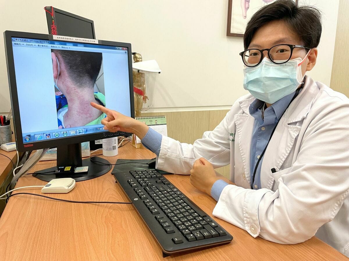 黃琦雯醫師表示，一位30多歲的李先生異位性皮膚炎發作就時常抓到破皮流血，後至中醫門診3個月後，病況即穩定可不用服藥。 圖：恩主公醫院提供