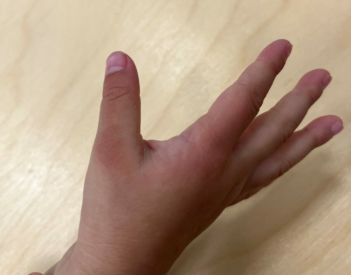 幼童手被櫃子夾傷。 圖：白喬茵服務處/提供