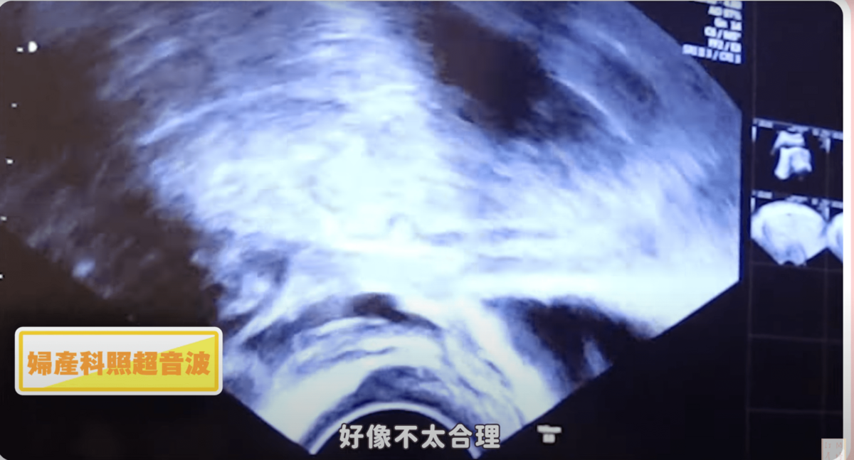陳彥婷在家驗到淡淡的兩條線，但照超音波時卻找不到胚胎。 圖：翻攝自YT/陳彥婷Tiffany
